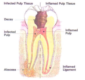 Infected tooth