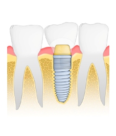 Dental Implants Dr. Wolfson