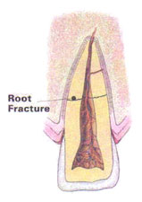 Root Fracture